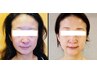 【冷凍幹細胞上清液】1A（4本）＋水光付◆ 肌質改善、広範囲部分集中ケア！