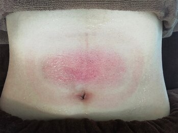 クールヴィラ(Cool Villa)/施術の流れ5