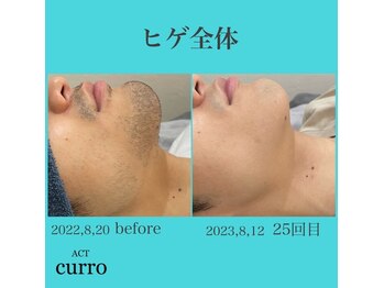 アクト クロ(ACT curro)/【ヒゲ全体】脱毛施術例