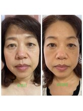 サロン ド アヤ(salon de Aya)/エイジング+小顔