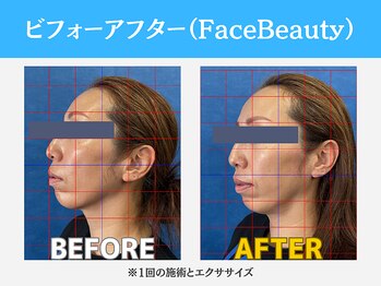 キャリッジスポーツ 盛岡(Carriage Sports)/ビフォーアフター【小顔】