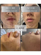 メゾン カルム 天文館店(MAISON CALME)/肌質改善