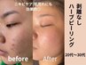 【3名様限定★飲む日焼け止めプレゼント】本気の肌質改善12回コース￥132,000