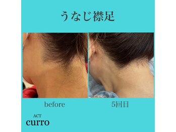 アクト クロ(ACT curro)/【うなじ襟足】脱毛施術例