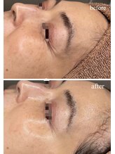 チェリーブロッサム 川越店(CHERRY BLOSSOM)/韓国水光ララピール♪