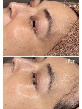 チェリーブロッサム 川越店(CHERRY BLOSSOM)/韓国水光ララピール♪