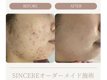 シンシア(SINCERE)/オーダーメイド肌改善プログラム