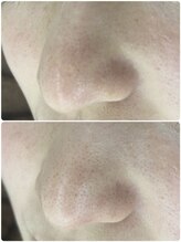 ビンナ(BINNA)/ビフォーアフター【毛穴洗浄】