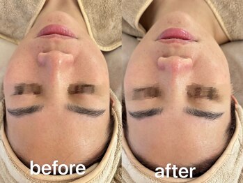 リベレスタ(liberesta)/幹細胞導入