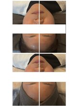 アロラヴィ(AroRavi)/大口式小顔矯正