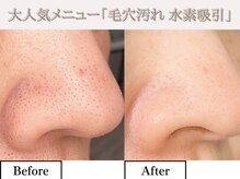 レオン(REONE)/【黒ずみ・毛穴はプロにお任せ】