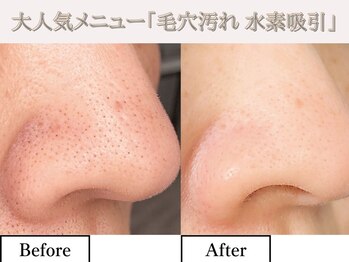 レオン(REONE)/【黒ずみ・毛穴はプロにお任せ】