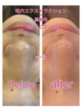 リジュベ(Rejuve)/毛穴洗浄/ブライダル/船橋エステ