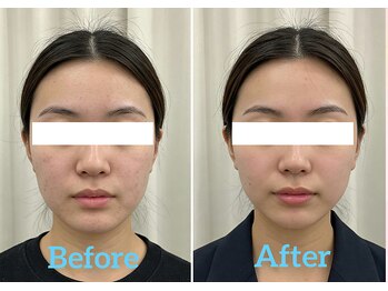 なごやの森/小顔・輪郭矯正ビフォーアフター