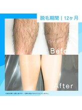 メンズクリア イオンモール東浦店/【メンズクリア】お客様の施術例