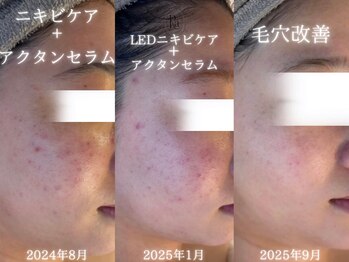 アールエーサロン 恵比寿 広尾(Ra salon)/1年のお肌の変化