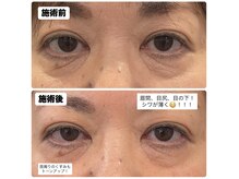 アンジープラス(ANZY+)/アイパワーエステ