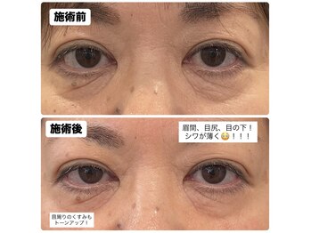 アンジープラス(ANZY+)/アイパワーエステ