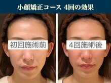 キュープ 表参道店(Qpu)/継続が「小顔」と「美」をつくる