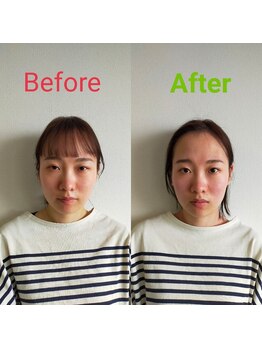 シャルム(Charme)/小顔矯正＋全身美容整体施術１回