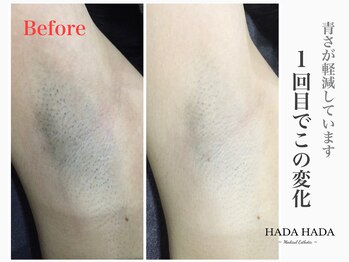 ハダハダ(HADA HADA Medical Esthetic)/ワキ脱毛もたった1回でこの効果
