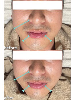 クレアナ ザ ビューティー(KULEANA the beauty)/LDMデコルテ&リフティング