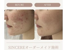 シンシア(SINCERE)/オーダーメイド肌改善プログラム