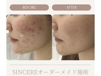 シンシア(SINCERE)/オーダーメイド肌改善プログラム