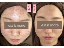 レスイズモア 恵比寿(less is more.)の雰囲気（腸と肌の見直しでたった2ヶ月でここまで綺麗に[ニキビケア/毛穴]）