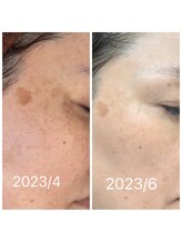 ククナ(KUKUna)/肌のトーンが明るくシミ改善