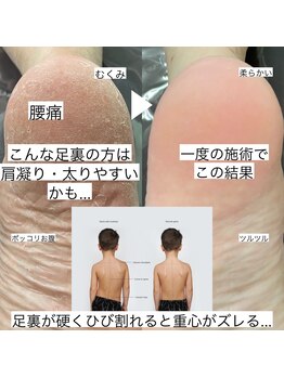 足裏角質除去【1】