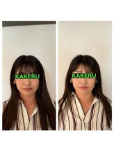 カケル鍼灸整体院(KAKERU鍼灸整体院)/美容鍼ビフォーアフター