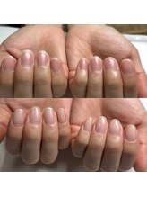 マニュコクーン(ManuCocoon)/爪育成　深爪　巻き爪　大阪