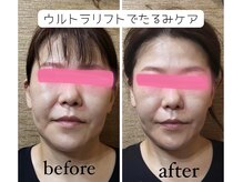 タマ 代官山(TAMA)の雰囲気（【毛穴/シミ/ニキビ/たるみケア】ウルトラリフトで引き上げる♪）