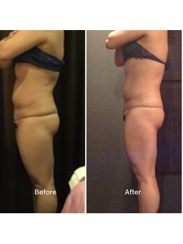 プラチナアース つくば店(Platinum earth)/痩身ビフォーアフター