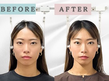 エルシンメトリー矯正院(ailesシンメトリー矯正院)/before＆after　ailes式小顔矯正