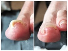 フレッシュフット(FreshFoot)/足のトラブルお任せください