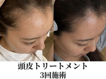 アムリリー 南草津店(AMRILY)/育毛頭皮トリートメント