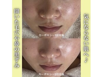 ハニエル(Haniel)/カーボキシー症例