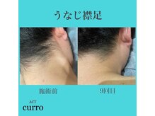 アクト クロ(ACT curro)/【うなじ襟足】脱毛施術例