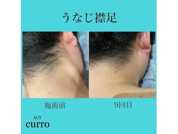 アクト クロ(ACT curro)/【うなじ襟足】脱毛施術例