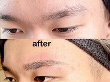 ランプ(LAMP)/〈男性〉ミラノブロウリフト