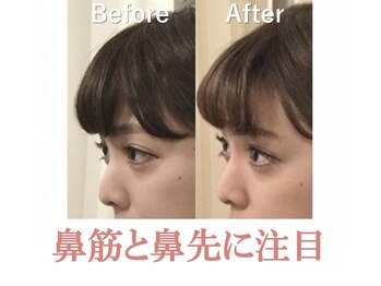 ラプリ 浜松店(Raplit)/ 隆鼻＋輪郭矯正40分10回