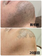 ハチ シンス 2023-(hachi-since 2023-)/【メンズ脱毛】　Before・After