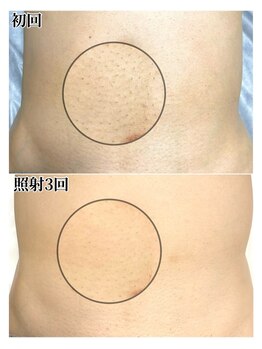 ルシャトン(Le Chaton)/おなか脱毛