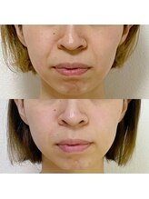 ジョンミー(JONMEE)/ほうれい線ケアには小顔矯正！