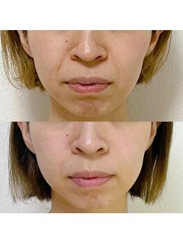 ジョンミー(JONMEE)/ほうれい線ケアには小顔矯正!