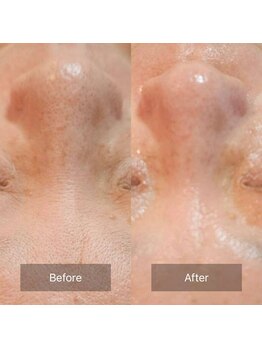 ローハ(ROHA)/炭酸導入:美白ツヤ肌ニキビケア