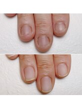 ネイルサロン アイリー(Nail salon Irie)/長年のお悩み【深爪】卒業！！☆