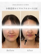 ルミア(LUMIA)/小顔造形ロイヤルフルコース１回